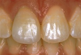 after picture of patient with dental crowns