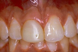 before picture of patient without dental crown