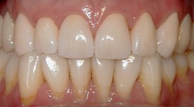 after picture of patient with dental crown