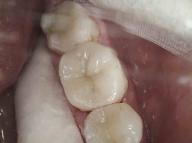 after picture of patient with dental crown