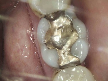 before picture of patient without dental crown