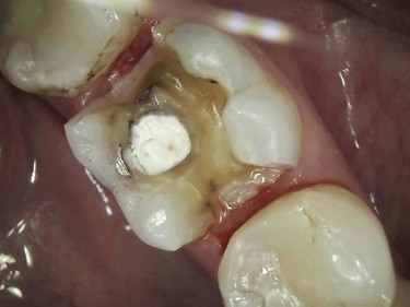 before picture of patient without dental crown