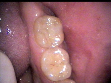after picture of patient with dental crown