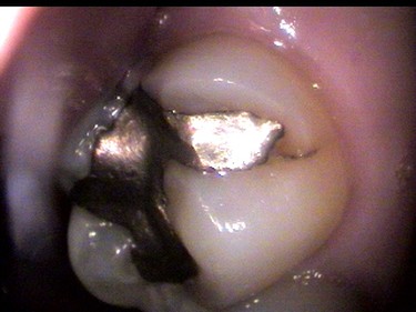 before picture of patient without dental crown