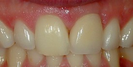 after picture of patient with dental implants