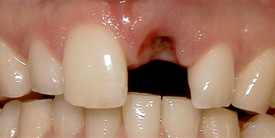 before picture of patient without dental implants