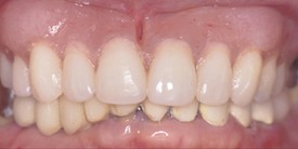 after picture of patient with dentures