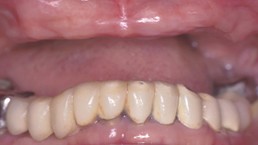 before picture of patient without dentures