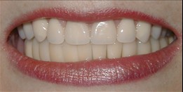 after picture of woman wearing dentures