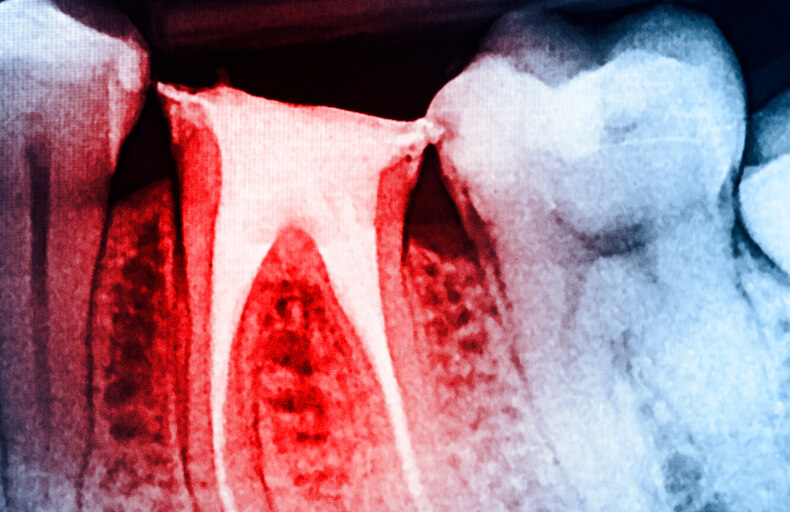 close up of an infected tooth X-ray